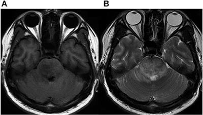 Encephalic Schistosoma japonicum resembles brainstem neoplasm: Case report and literature review